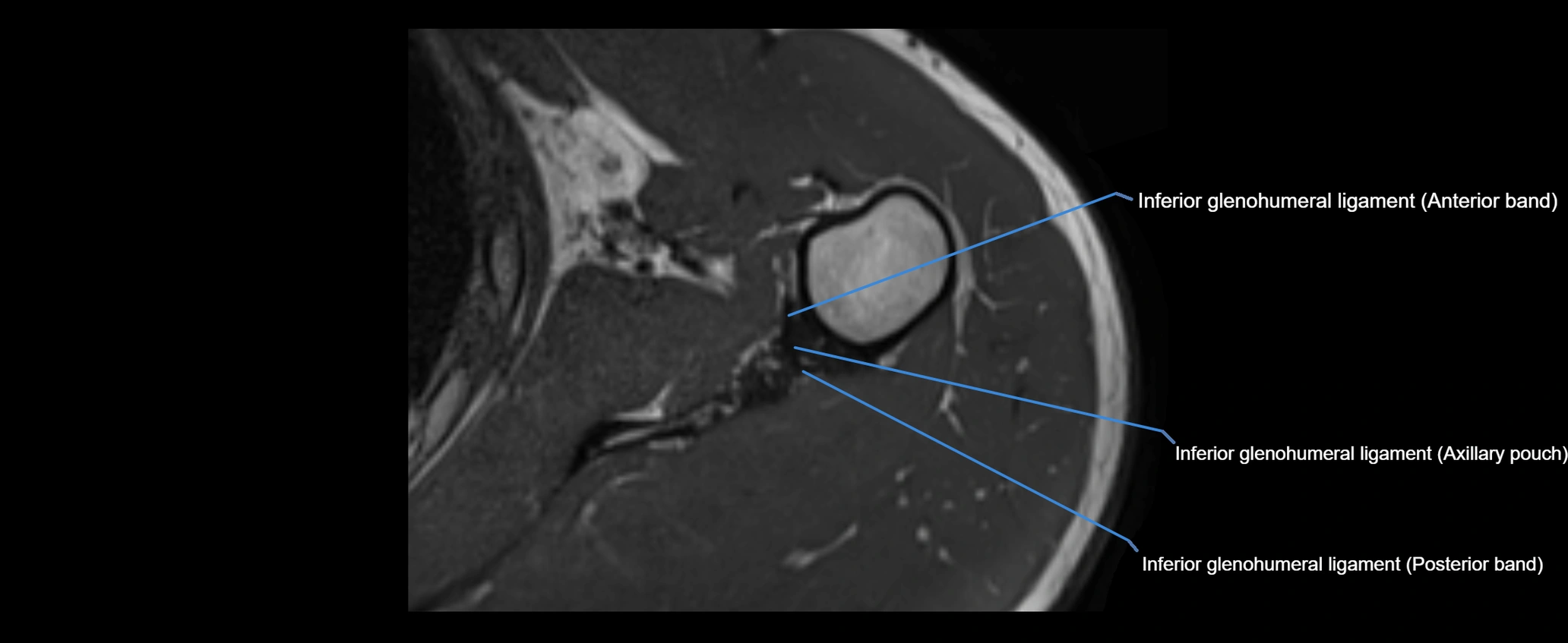 shoulder ligaments axial 3d 3t mri image-img-00005-00089.webp